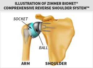 zimmer biomet shoulder replacement