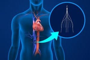 Illustration of an IVC Filter